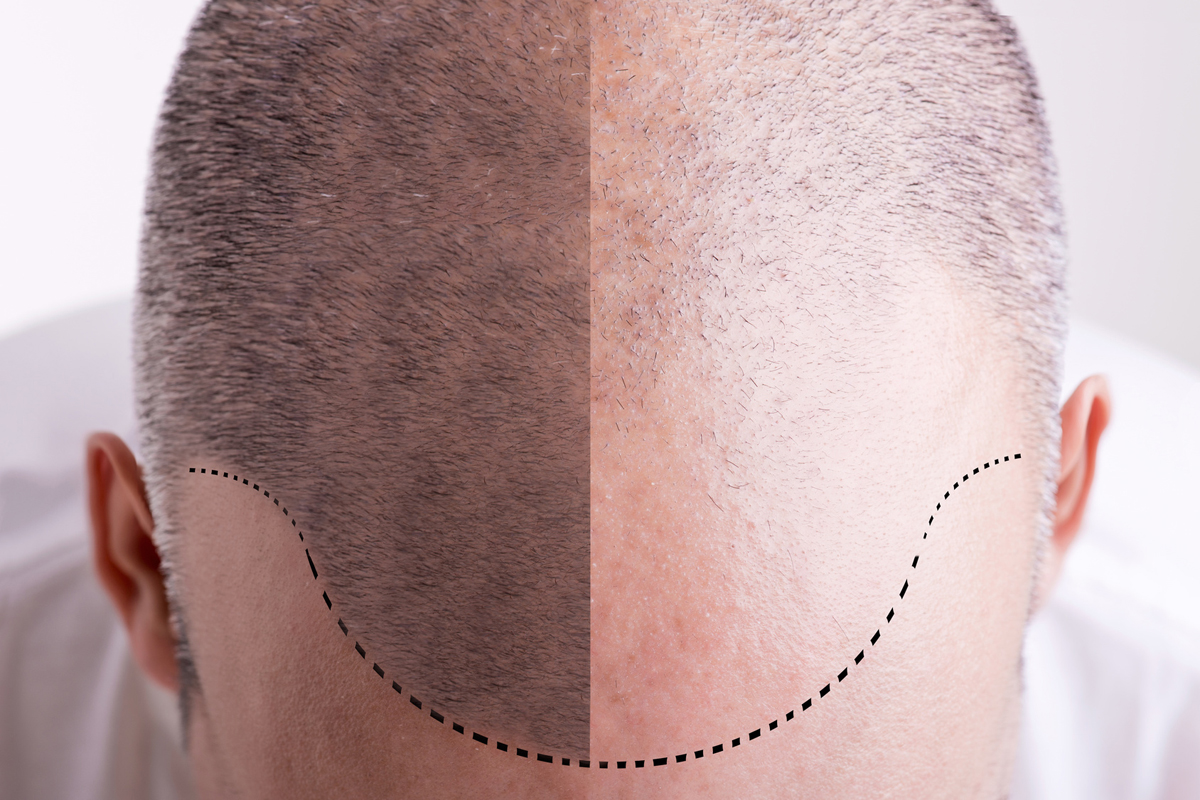 Démonstration Esthétique : Le roller dans la dermopigmentation du cuir chevelu