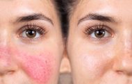 Conférence Esthétique : Comprendre l’acné et la rosacée