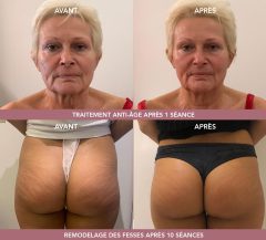 Indiba Deep Beauty France